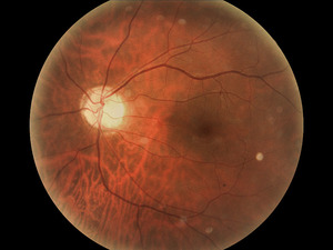 Deep Learning for Diabetic Retinopathy Diagnostics