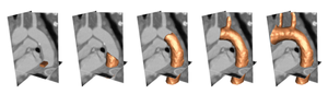 Level Set Based Automatic Segmentation of Human Aorta