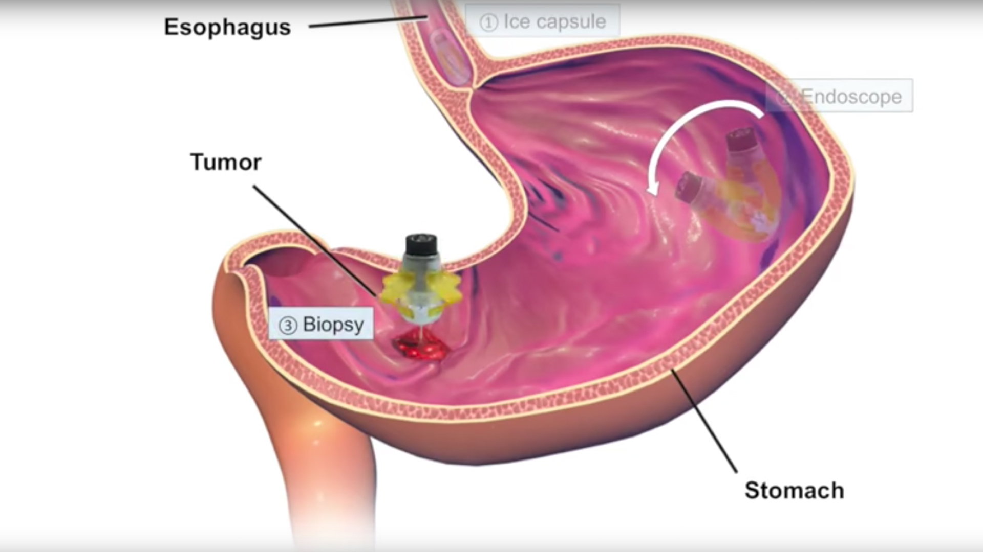 A colonoscopy robot