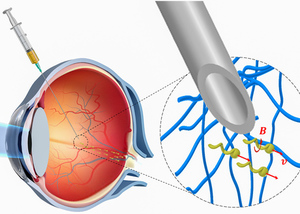 Thumb ticker sm nanoroboter werden ins auge injiziert