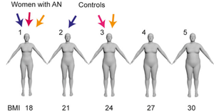 Investigating Body Image Disturbance in Anorexia Nervosa Using Novel Biometric Figure Rating Scales: A Pilot Study