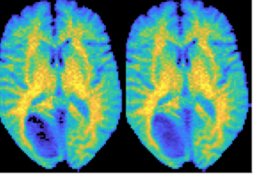 Mri