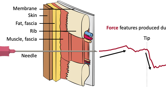Comparing Puncture-Detection Approaches for Manual Needle Insertions Through the Parietal Pleura